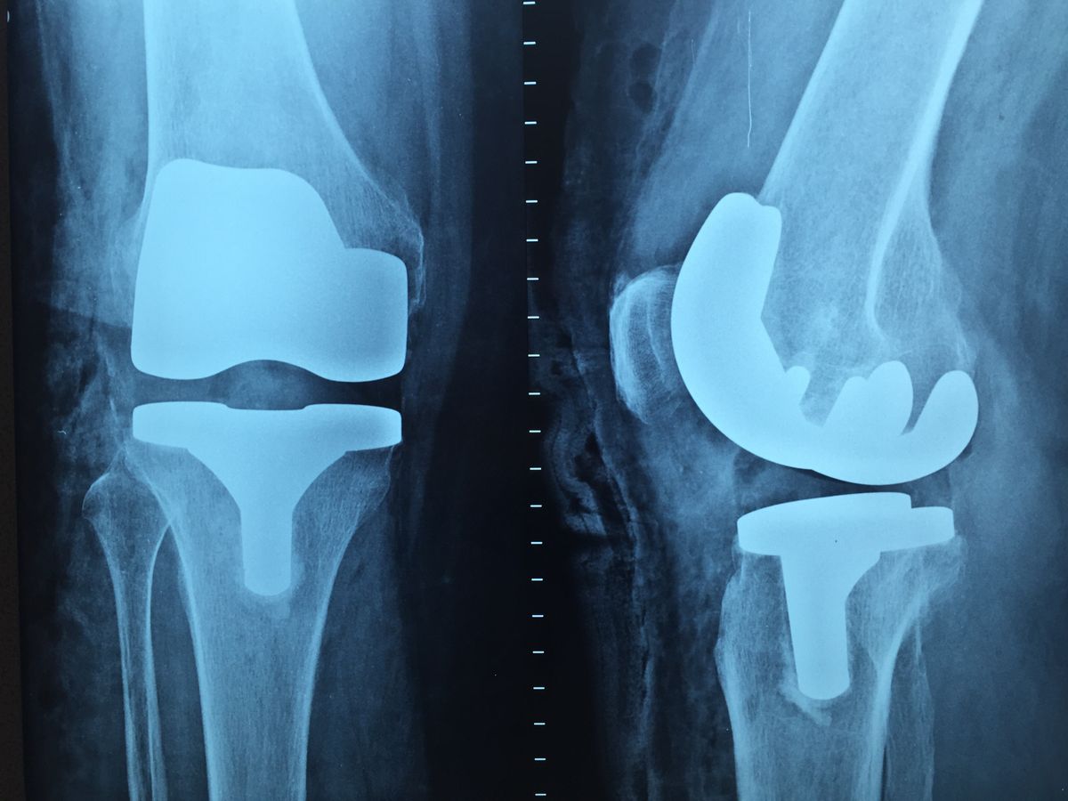 Radiografía de una prótesis de rodilla