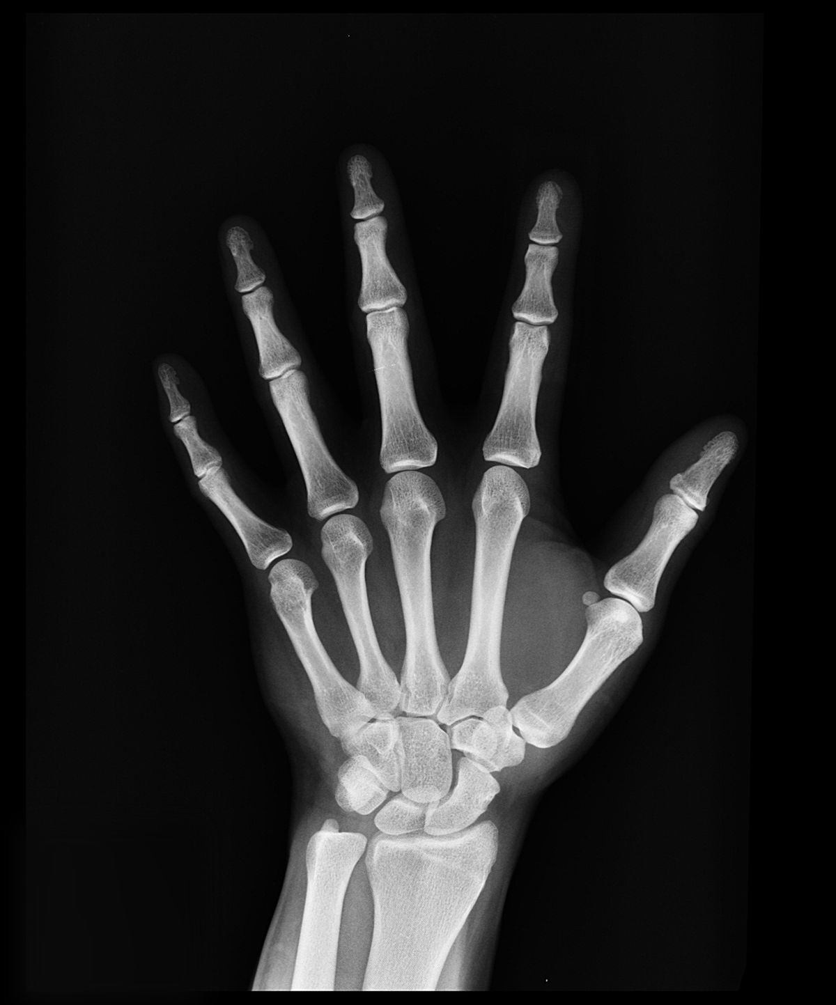 Radiografía de los huesos de la mano